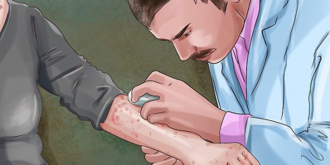 اختلال خراشیدن پوس